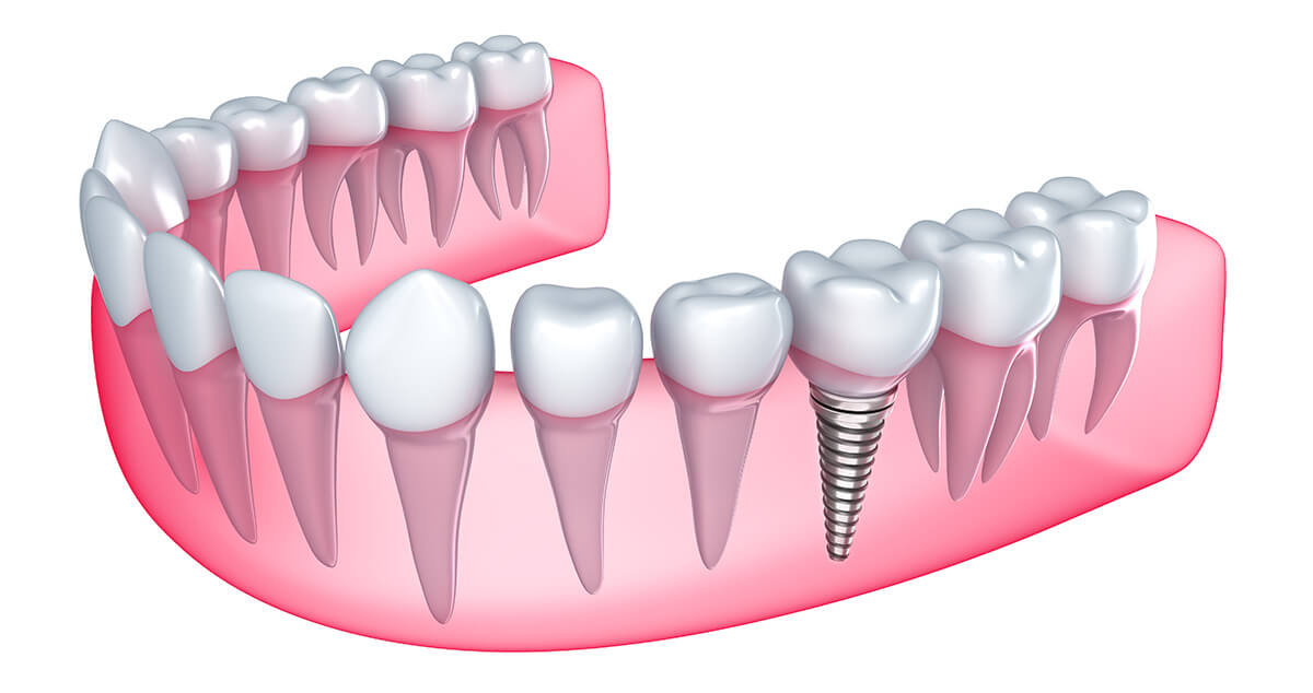 implant tedavisi ankara