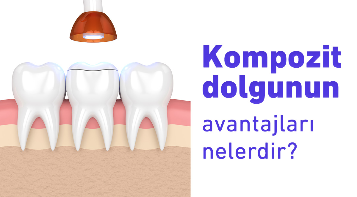 kompozit dolgunun avantajları nelerdir