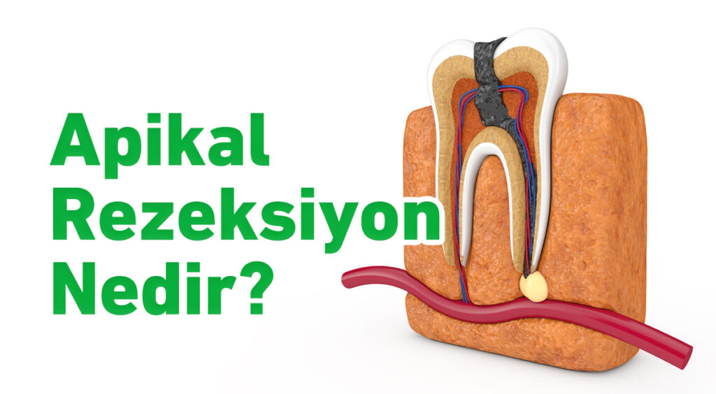 Apikal Rezeksiyon Nedir? - Dr. Dt. Seda Yıldırım