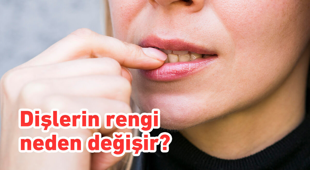 Dişlerin rengi neden değişir?