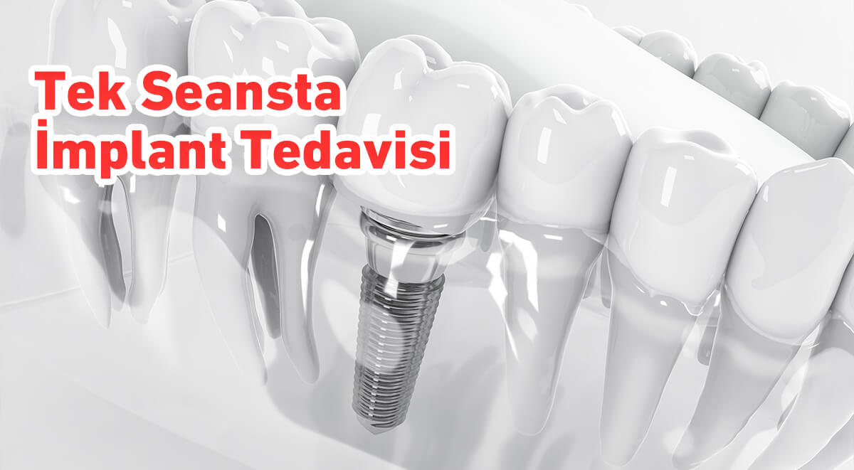 Tek Seansta İmplant Tedavisi